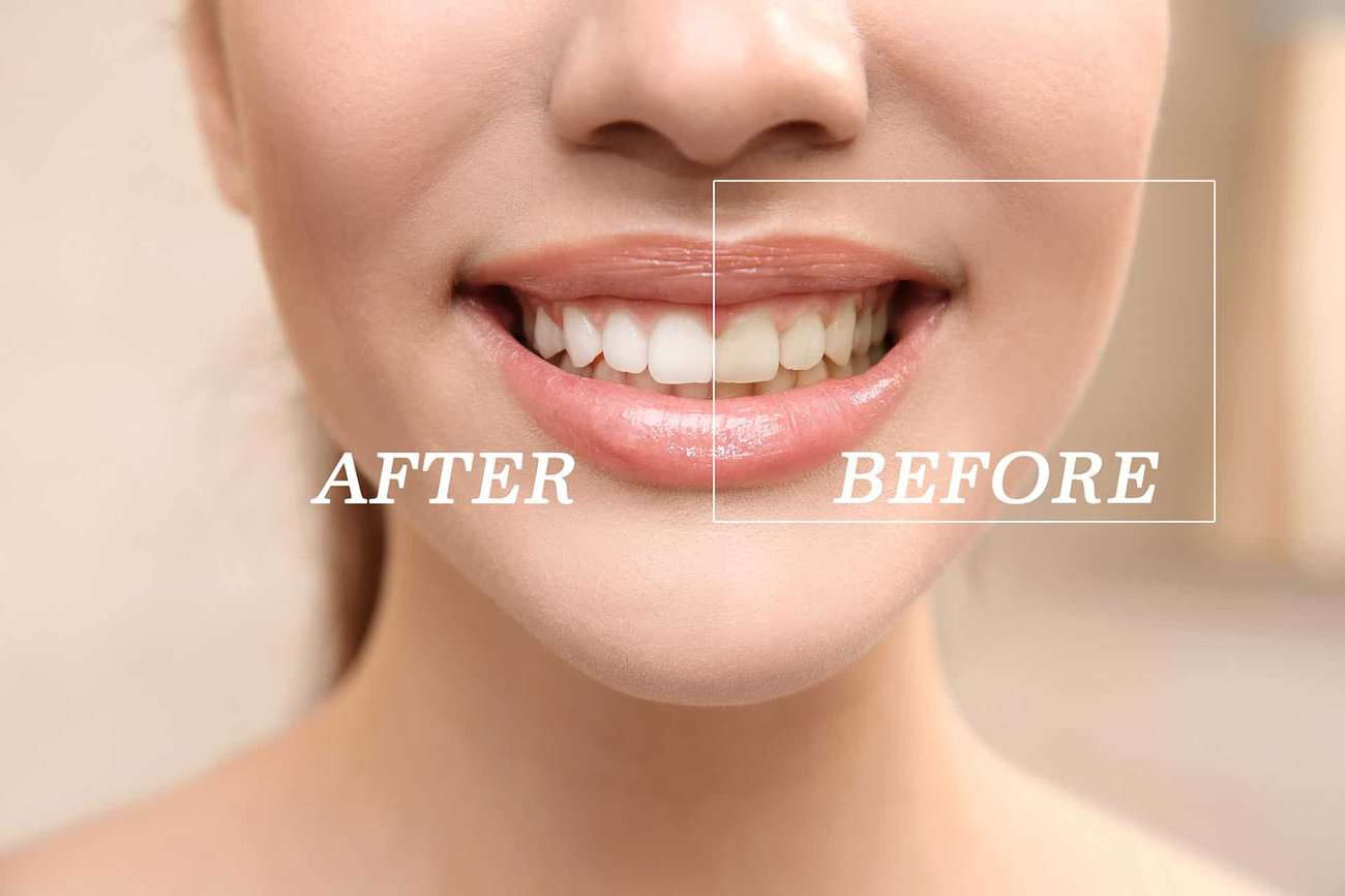 How Can You Maintain a Consistent Smile Shade with Crowns Beckenham?