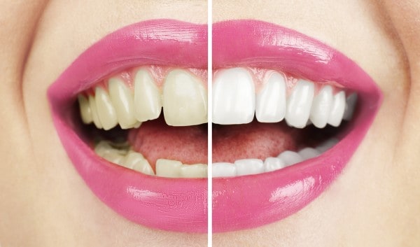 What Early Signs of Oral Cancer Should You Never Ignore Beckenham?