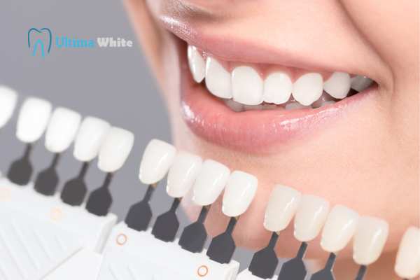 How to Maximise the Results of Your Laser Teeth Whitening Treatment Beckenham