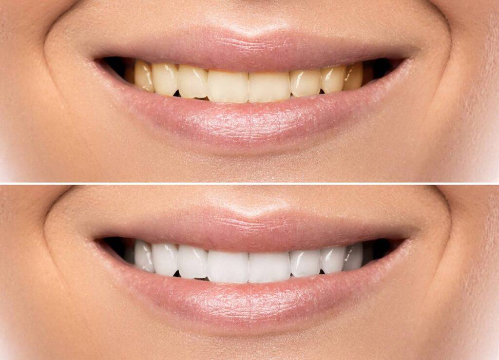 How Does Gum Disease Progress if Left Untreated Beckenham?