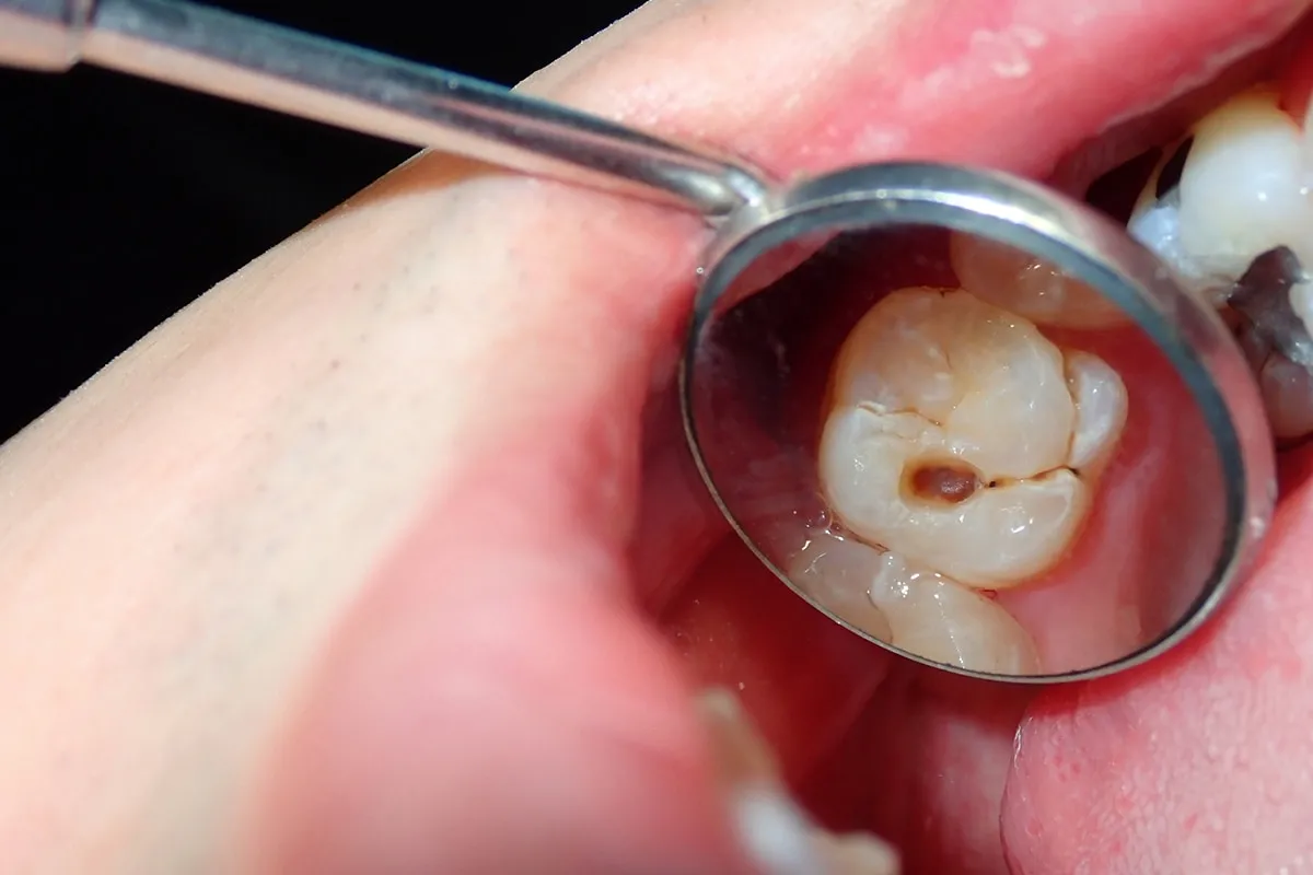 Why Do Teeth Crack? Common Causes to Know Beckenham