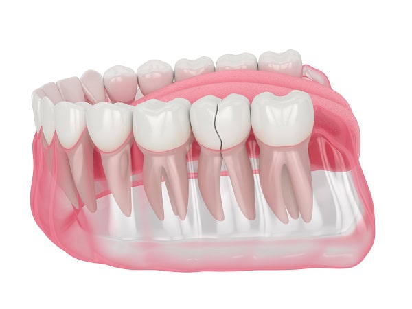 How Can You Manage Pain and Discomfort After a Root Canal Beckenham?