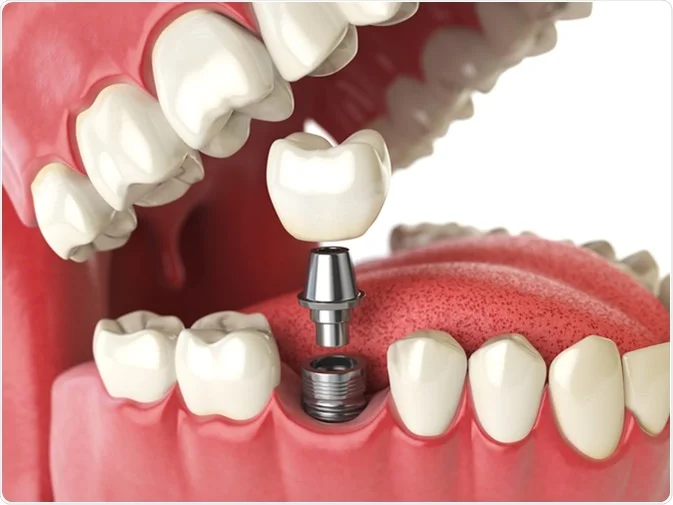 How Do I Decide Which Tooth Replacement Is Right for Me Beckenham?