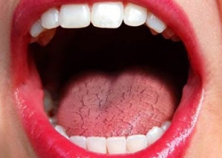 Common Causes of Dry Mouth (Xerostomia) Beckenham