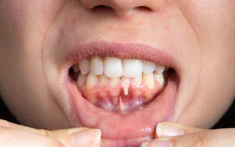 How Can Gum Disease Be Prevented Beckenham?