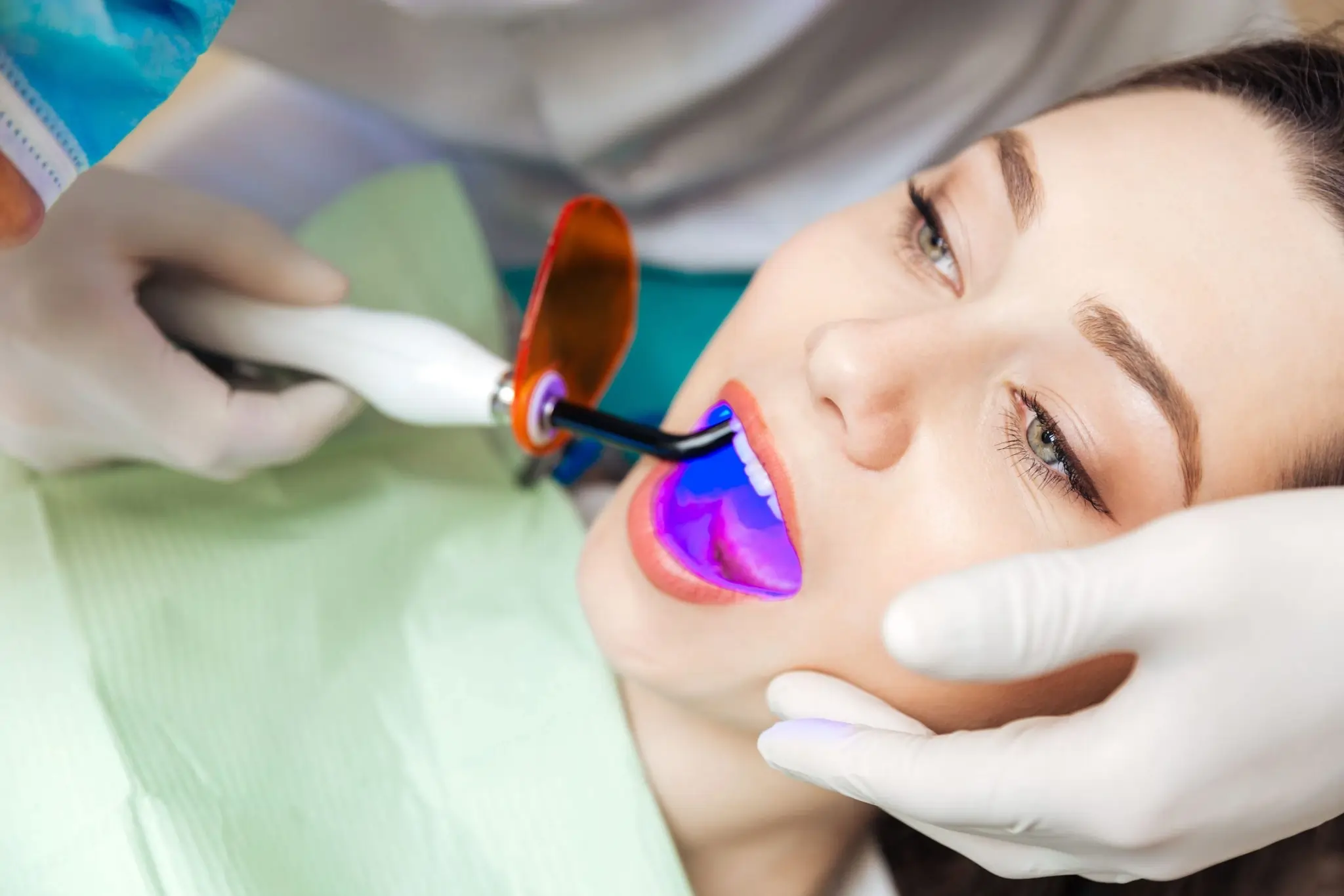 Common Risks of Whitening Without Expert Dental Guidance Beckenham