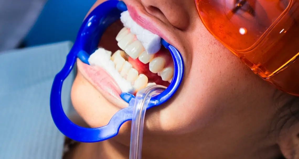 FAQs: Laser Teeth Whitening vs. At-Home Kits Beckenham