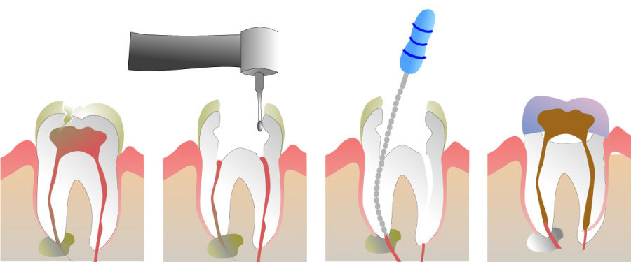 How Do You Properly Care for Your Teeth After a Root Canal Beckenham