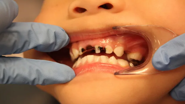 Which Foods and Drinks Cause the Most Damage to Young Smiles Beckenham?