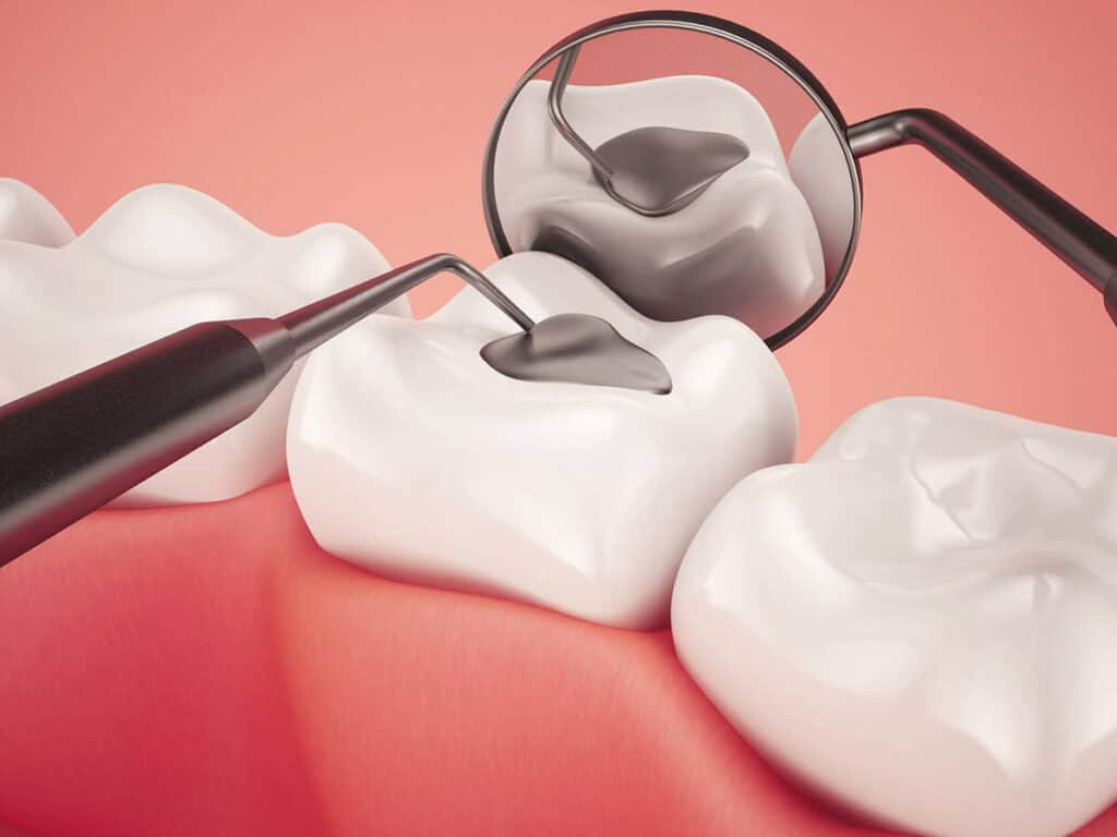 Fighting Cavities and Plaque Buildup Beckenham