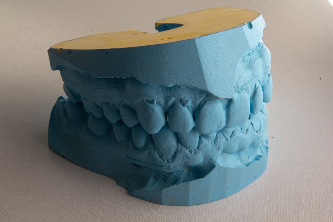 How Do Dental Implants Improve Jawbone Health and Oral Function Beckenham?