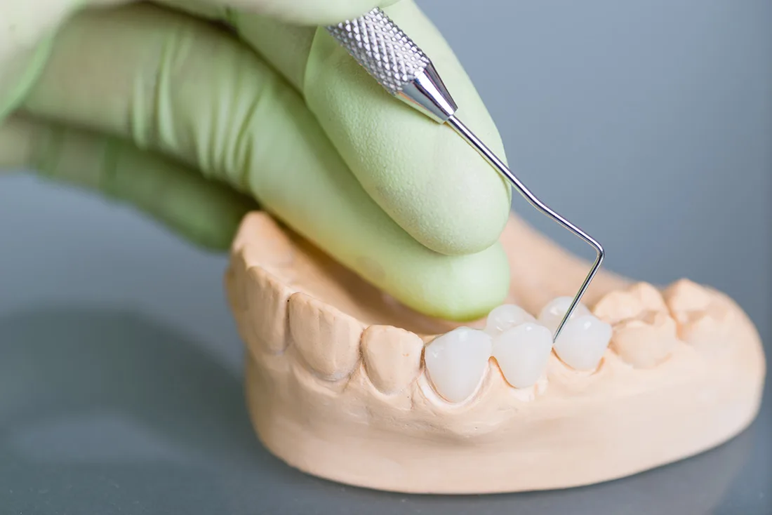 Do Braces Take Years to Show Results Beckenham