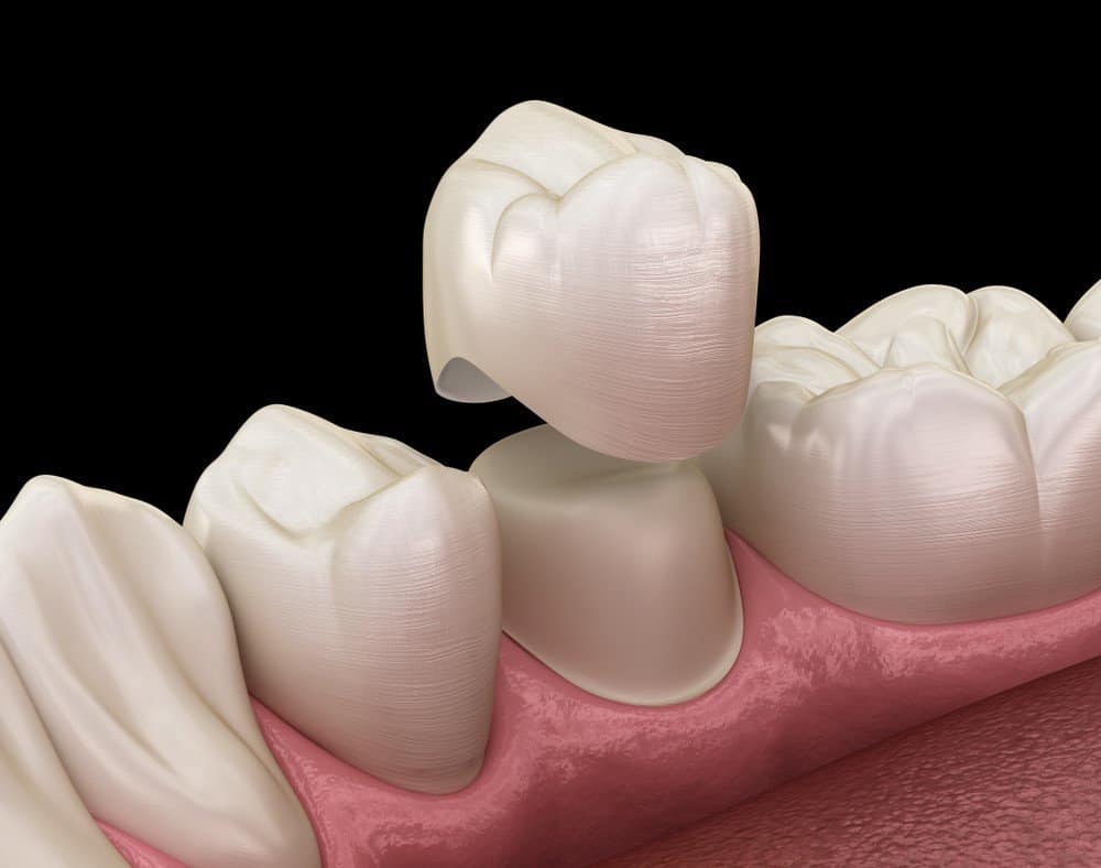 Teeth Whitening: Separating Facts from Fiction Beckenham