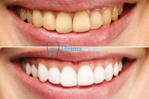 Why Might Multiple Whitening Sessions Be Necessary Beckenham?