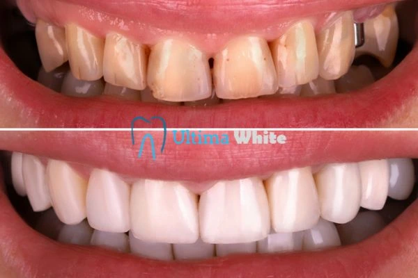 What Makes Instant Teeth Whitening Treatments So Popular Beckenham?