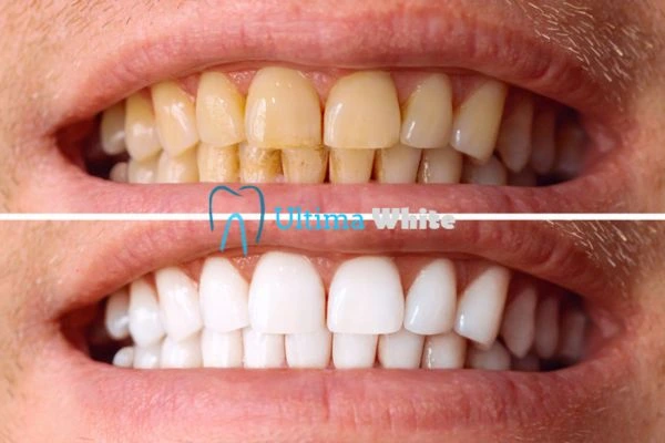 Stained Teeth and Persistent Bad Breath Beckenham