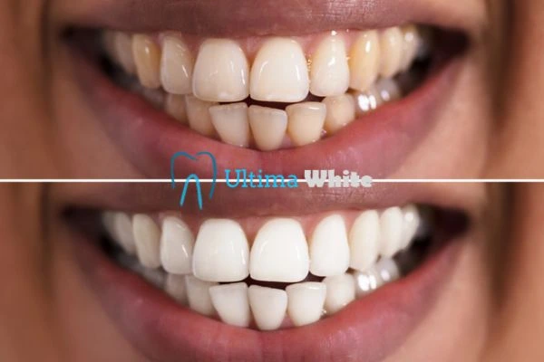 Aftercare Tips to Maintain Your New Smile Beckenham